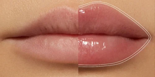 グロスを塗った唇と塗っていない唇の比較 - リッププランパーは本当に効果があるのか？効果と副作用を解説 2026 - Zicail