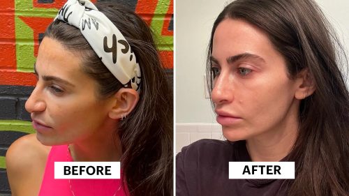 トラネキサム酸治療による女性の髪の変化を示すビフォーアフター写真 - トラネキサム酸:効果、用途、スキンケアのルーティンに関するヒント 2026 - Zicail トラネキサム酸治療による女性の髪の変化を示すビフォーアフター写真 - トラネキサム酸:効果、用途、スキンケアのルーティンに関するヒント 2026 - Zicail