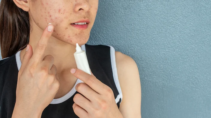 Applying cream to face with fungal acne breakout - How to Identify and Treat Fungal Acne 2026 - Zicail