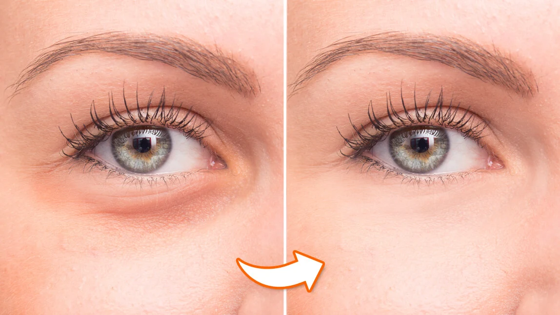 Eye bags before and after cosmetic treatment - How to Get Rid of Bags Under the Eyes 2026 - Zicail