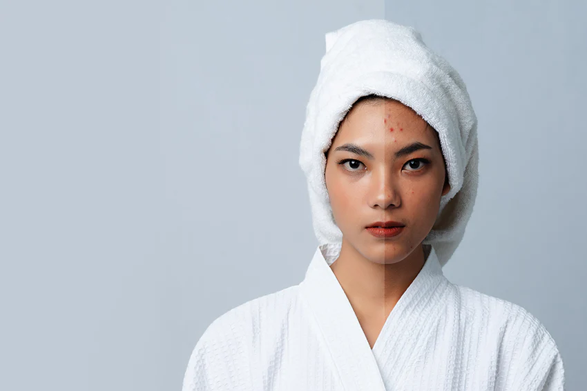Woman with towel on her head showing skincare progress - Licorice Root for Skin: Benefits, Uses & Safety 2026 - Zicail Woman with towel on her head showing skincare progress - Licorice Root for Skin: Benefits, Uses & Safety 2026 - Zicail