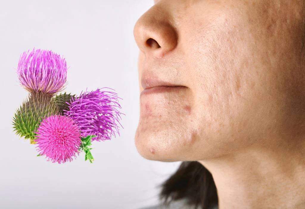Milk thistle flower near a person with acne scars symbolizing skin benefits - Milk Thistle for Skin: Benefits, Uses & Top Products 2026 - Zicail